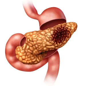 djt cystic neo pancreas 1 1024x1024