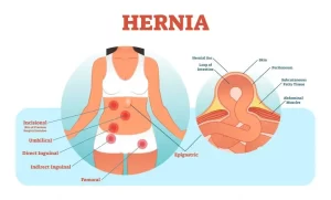 djt hernia 1 1024x619